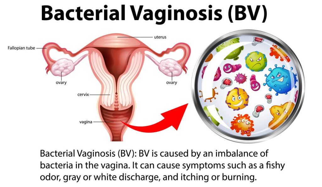 What is Bacterial Vaginosis