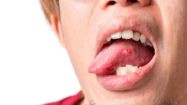 canker sores on tongue