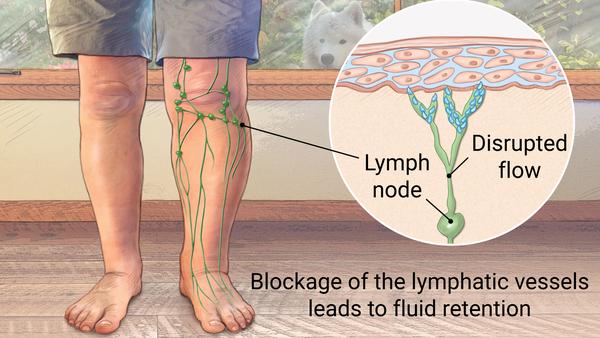 LymphOedema pathology