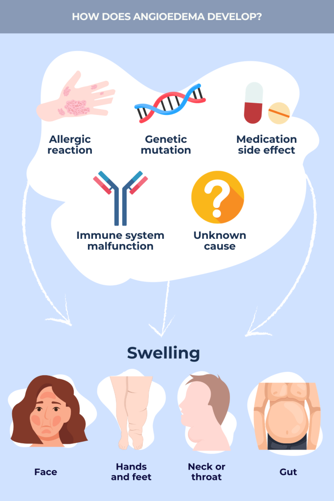 Angioedema development