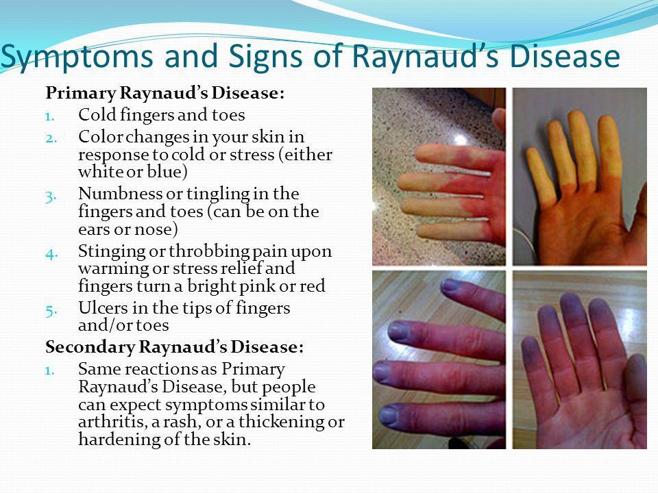 Symptoms of Raynold's Disease