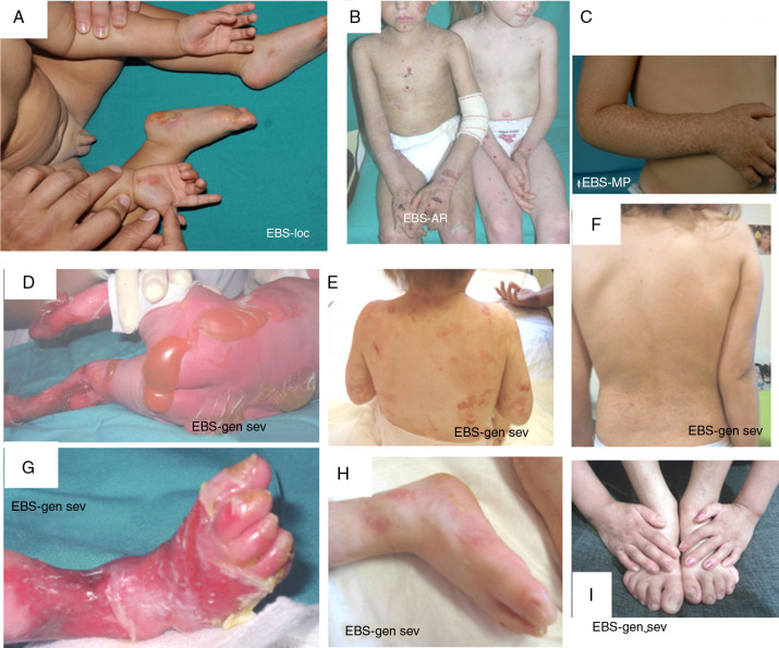 Typs of Epidermolysis Bullosa
