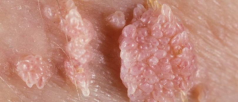 Genital Warts