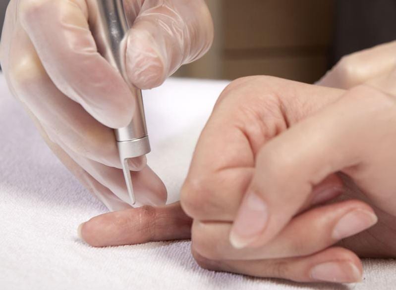 Laser treatment