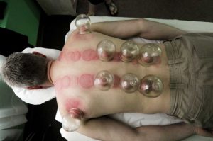 Dry Cupping