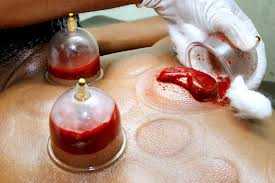 Hijama - Wet cupping