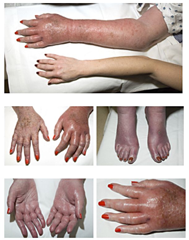 Symptoms of polycythenua vera