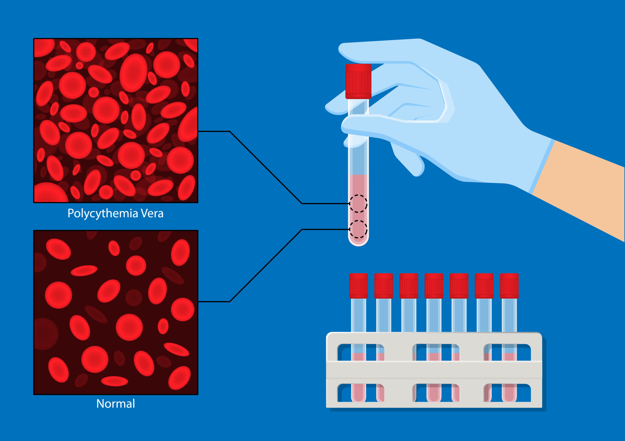 Erythrocytosis