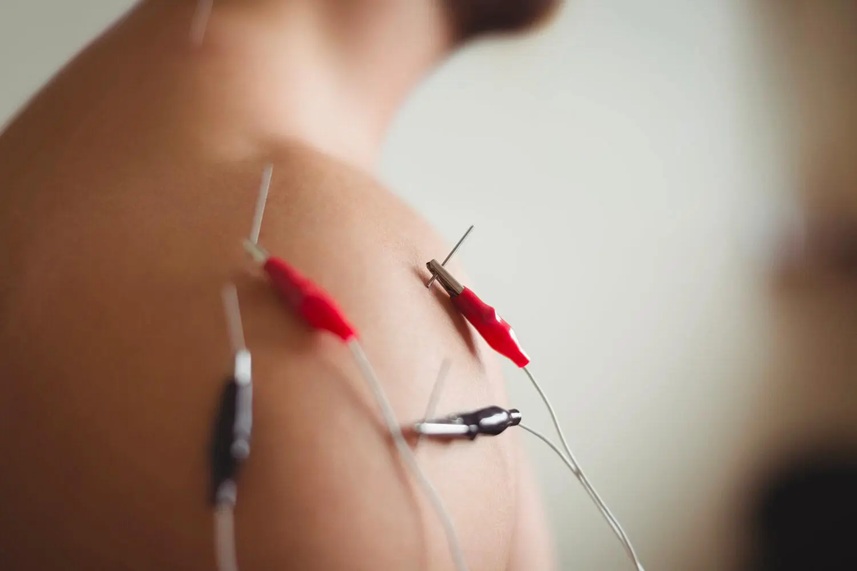 Acupuncture for TOS