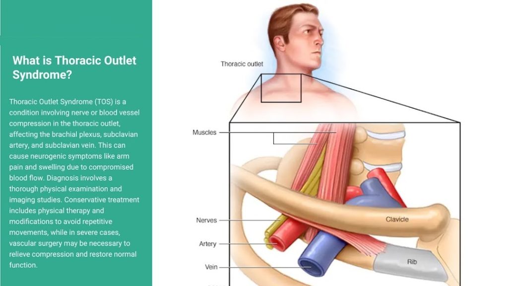 Thoracic outlet syndrome