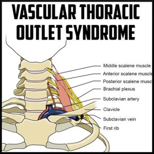 Vascular Thoracic outlet syndrome