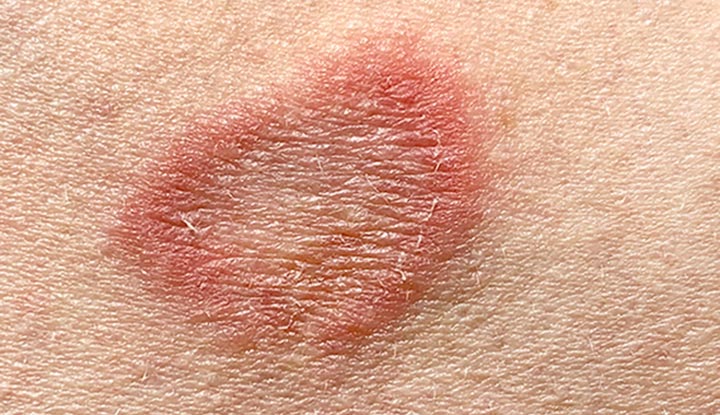 Tinea