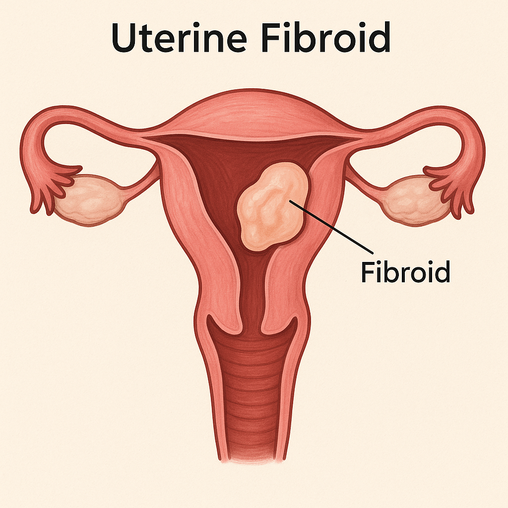 Fibroid in uterus