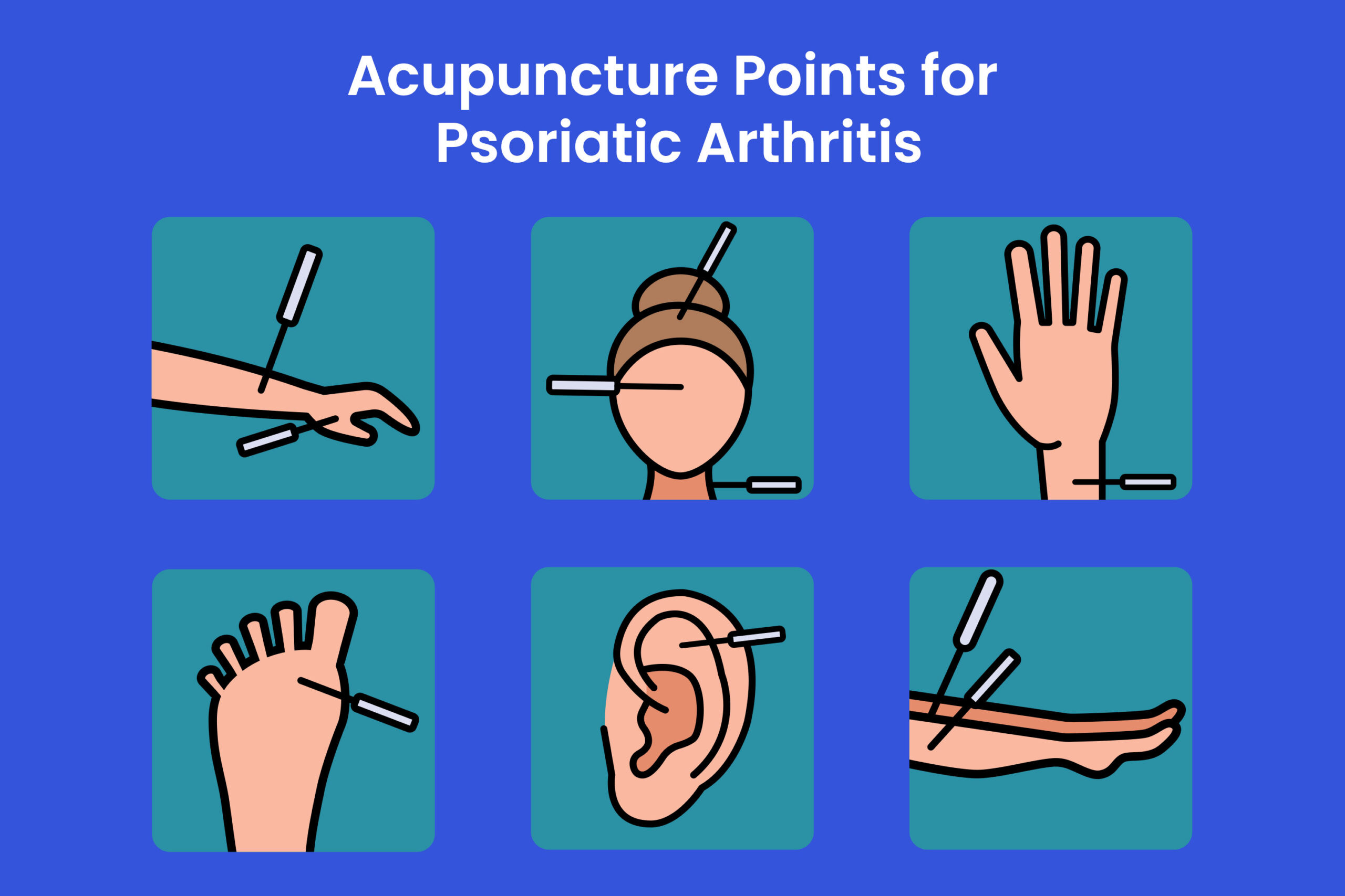 Acupuncture for psoriatic arthritis