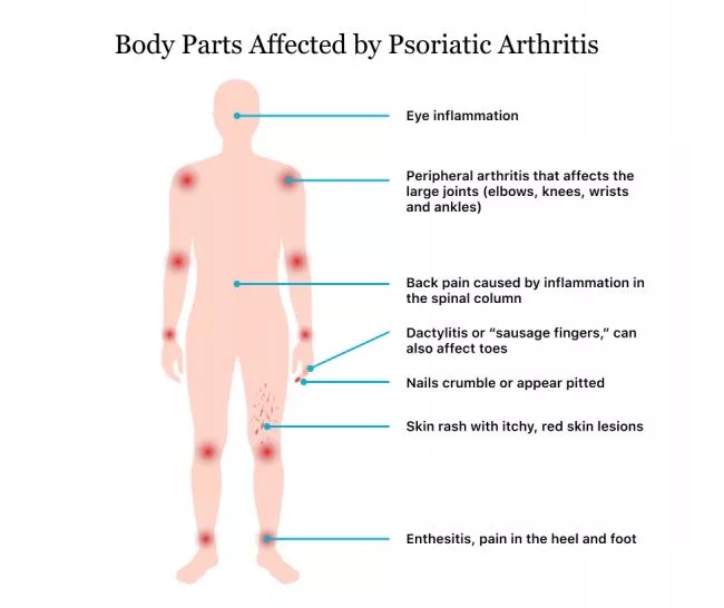 Body parts affected by psoriatic arthritis