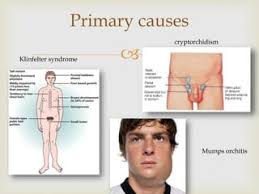Primary cause of hypogonadism in males