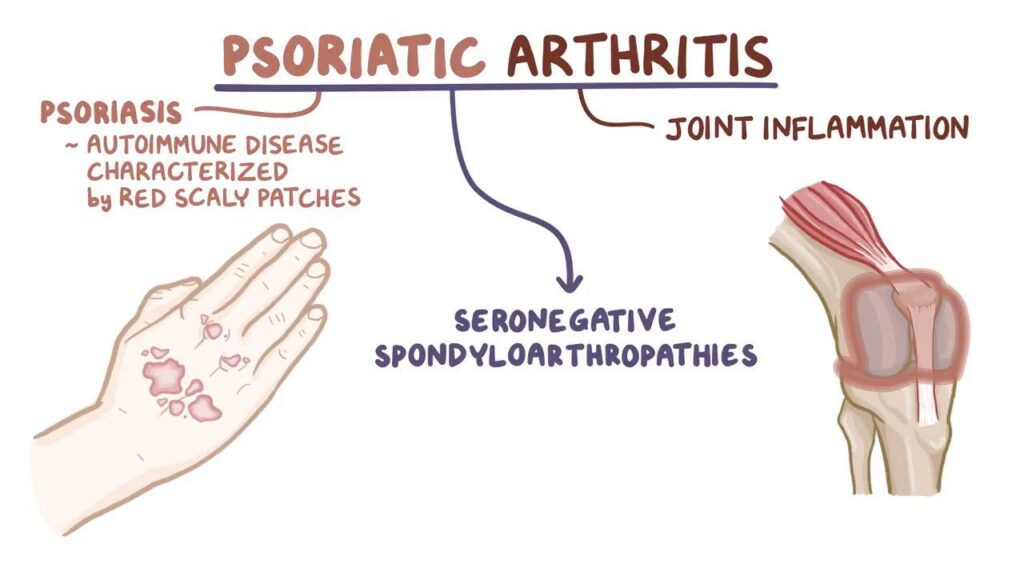 psoriatic arthritis