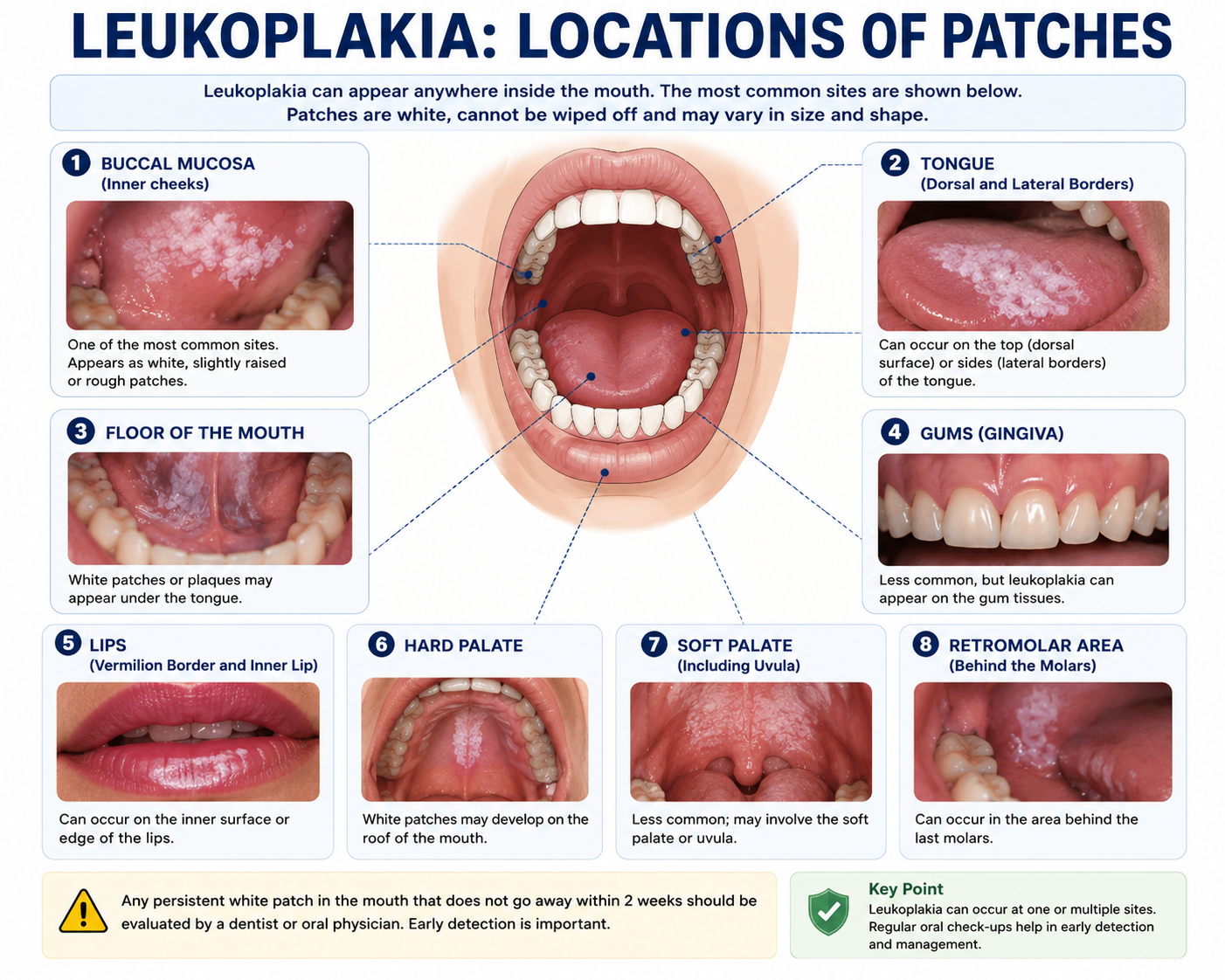 Leukoplakia: Patches Locations