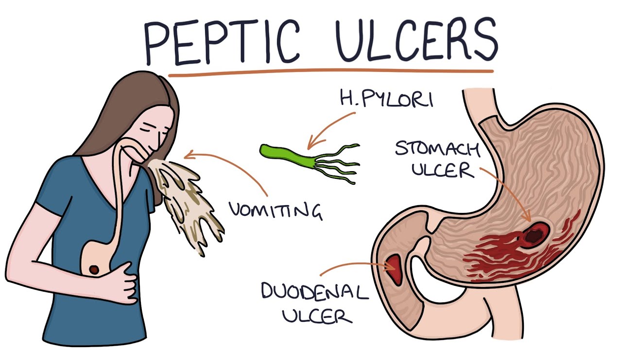 stomach ulcers