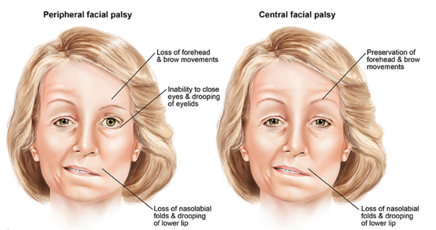 Bells palsy central and periferal