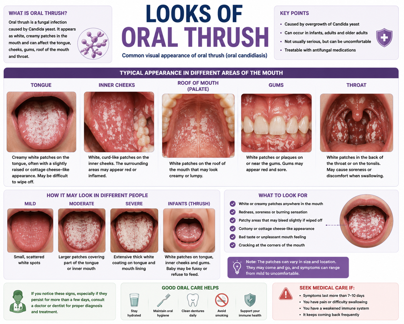Oral thrush clinical signs