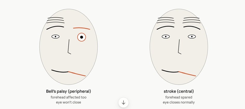 Peripheral palsy vs Central palsy